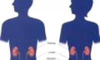 Women die earlier than men because of bladder cancer
